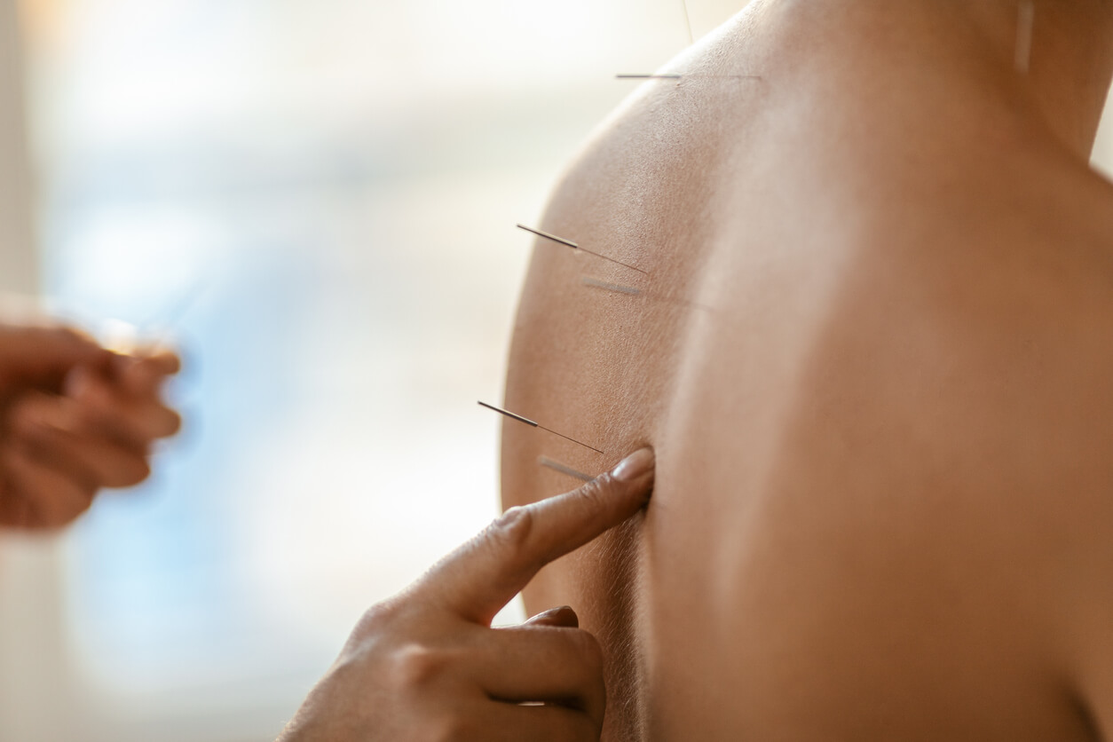 Acupuncture