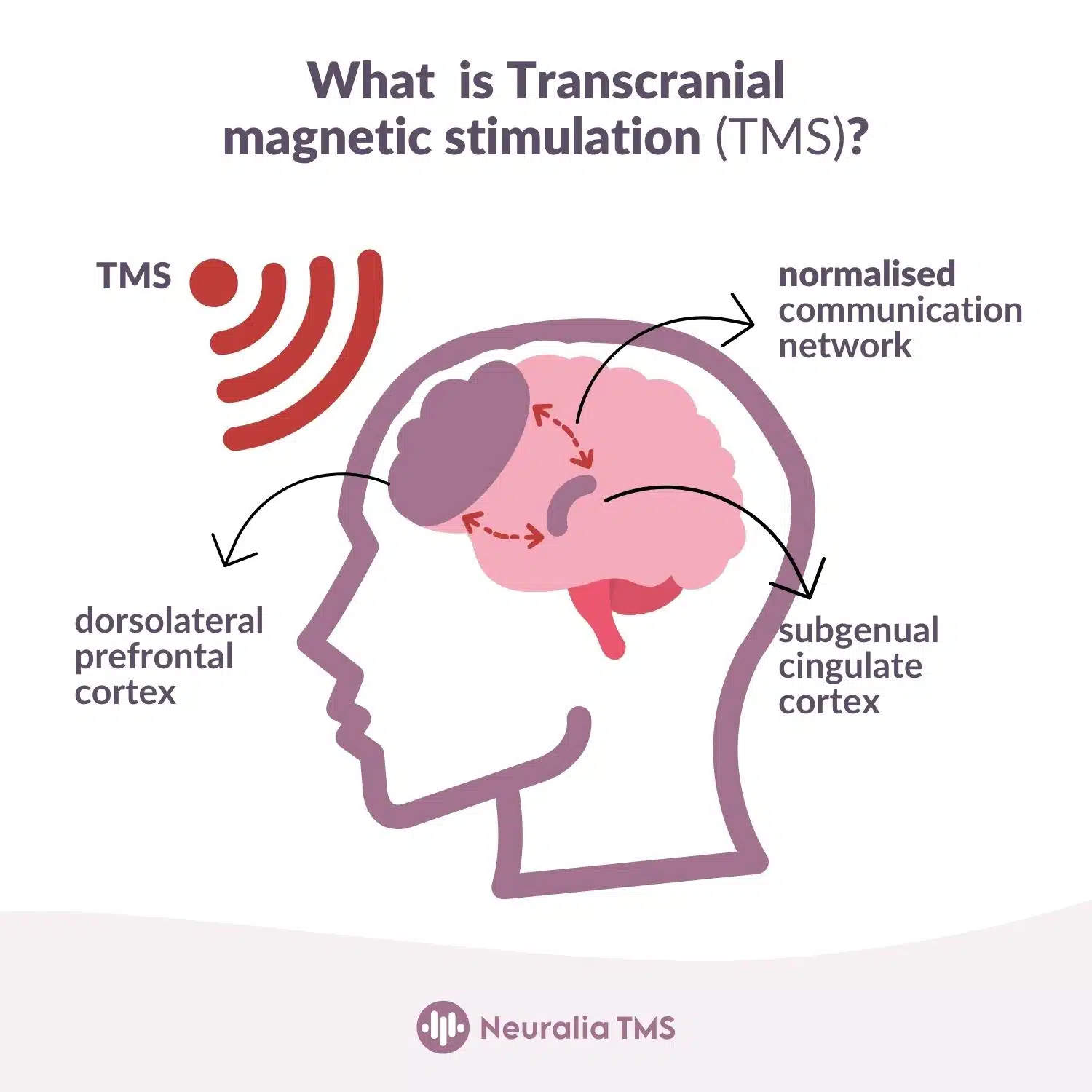 TMS (Transcranial Magnetic Stimulation)